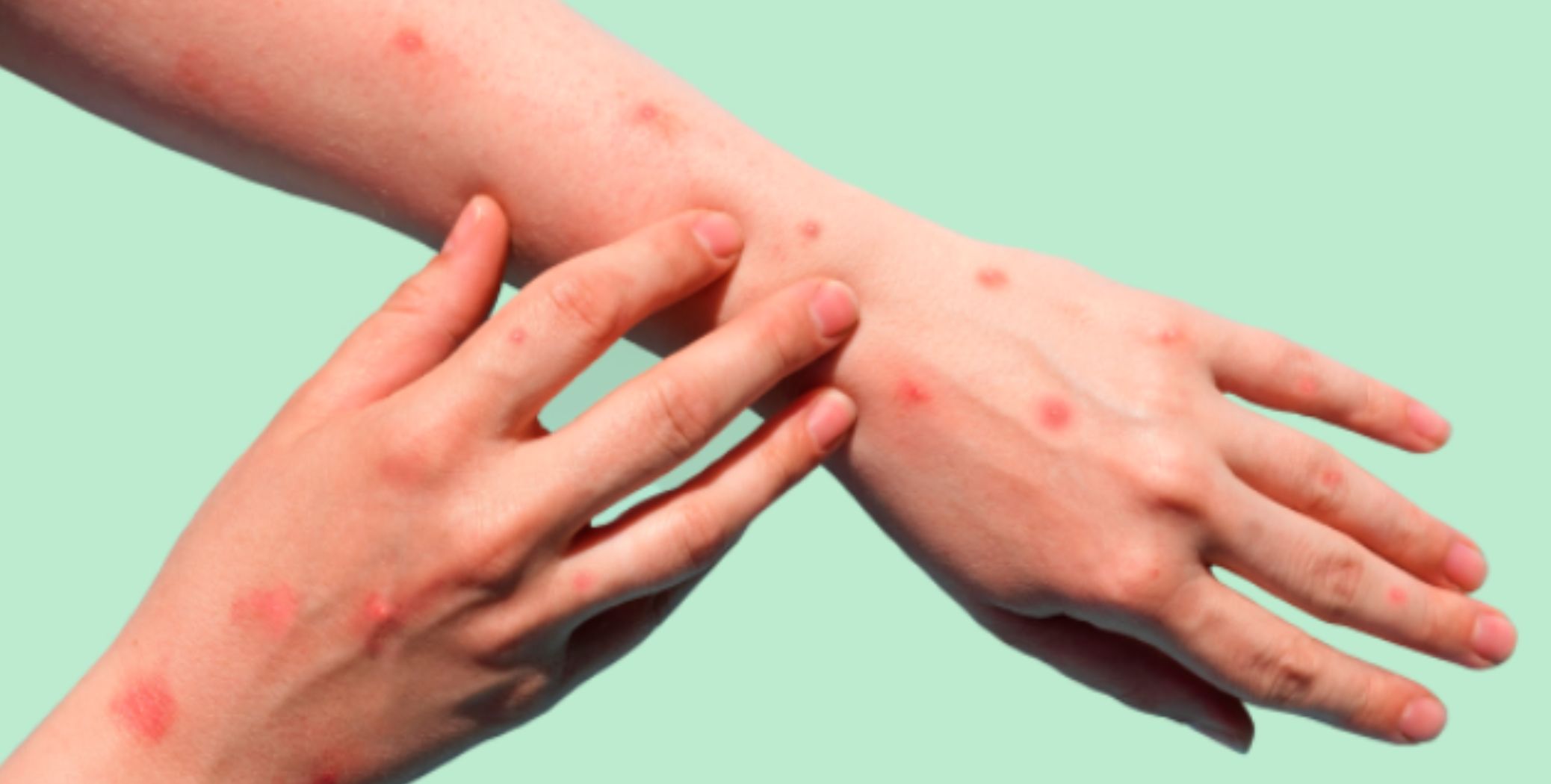 Hands and arms with measles