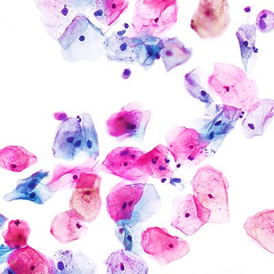Depiction of cervical cancer cells